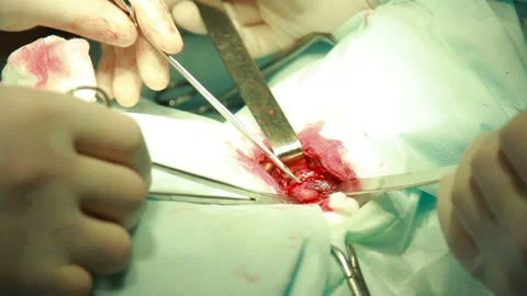 Surgery team operating Stock Footage 86598395