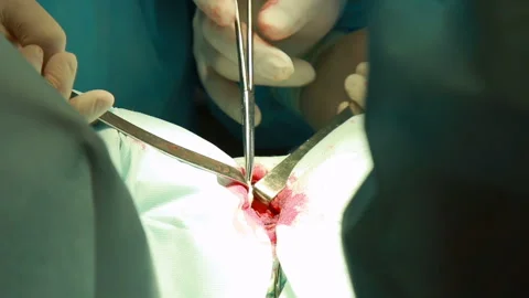 Surgery team operating Stock Footage 86598403
