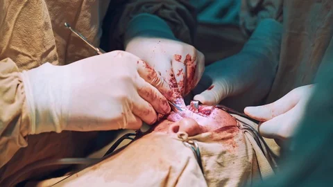 Surgery Team Operating Stock Footage 118699421