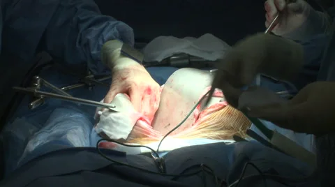 Surgery Theatre Operation Procedure Open Chest Stock Footage 47719619