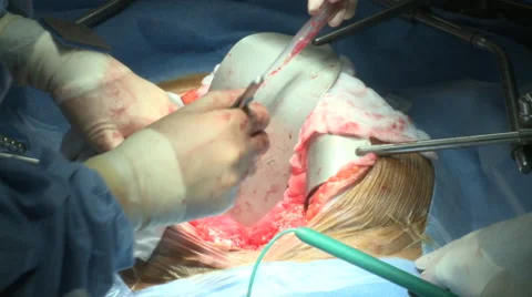 Surgery Theatre Operation Procedure Open Chest 2 Stock Footage 47719638