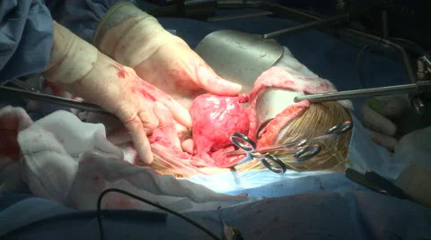 Surgery Theatre Operation Procedure Open Chest Removal Cyst Stock Footage 47720422
