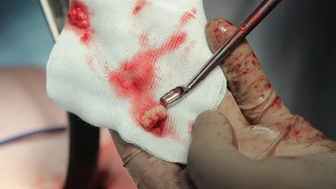 Surgical Bone Spoon and a Bone Material Close Up Photos