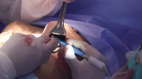 Surgical breast augmentation. Stock Footage 105183545