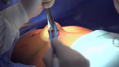 Surgical breast augmentation. Installation of a breast implant. Stock Footage 105010826