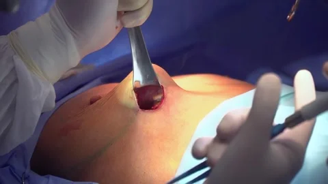 Surgical breast augmentation. Installation of a breast implant. Video stock 259476228