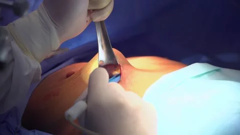 Surgical breast augmentation. Placement of a breast implant. Stock Footage 243636789