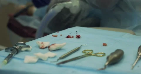 Surgical dental instruments on the table during tooth extraction surgery Stock Footage 166203922