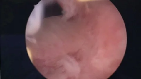 Surgical hysteroscopy. the surgeon performs an operation on the uterus.monitor Video stock 87004584
