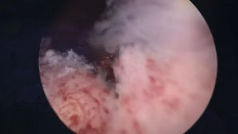 Surgical hysteroscopy. the surgeon performs an operation on the uterus.monitor Stock Footage 87004985