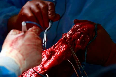 Surgical intervention Foto stock