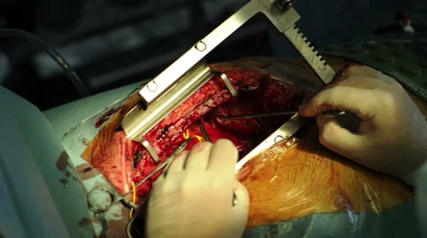 Surgical manipulation of heart Stock Footage 62747049