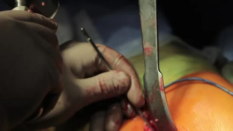 Surgical nails usage Stock Footage 295843688