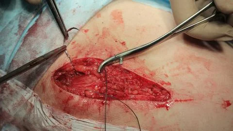 Surgical Needle And Thread In Use Фото