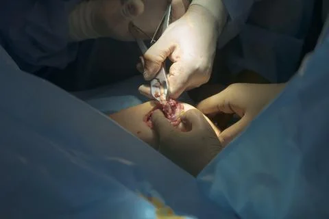 Surgical Nippers Usage Stockfoto's