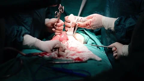 Surgical operation Stock Footage 133280971