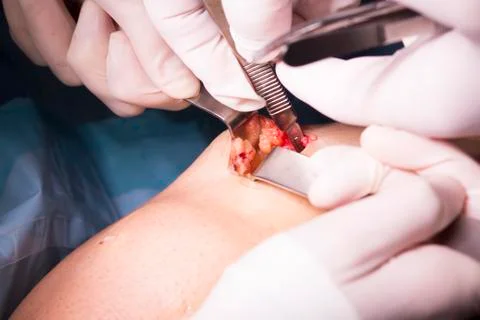 Surgical operation knee surgery Stock Photos