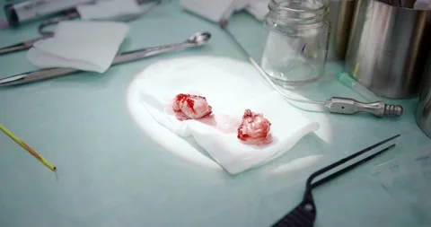 Surgical operation to remove tonsils. Tonsillectomy. Stock Footage 163913949