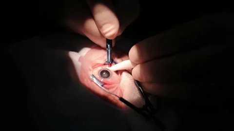 Surgical operations on the human eye Stock Footage 59319310