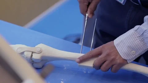 Surgical Pin Insertion into Tibia Bone Stock Footage 315066707