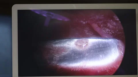 Surgical plastic surgery with an endoscope, endoscopic surgery Stock Footage 250111312
