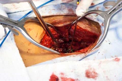 Surgical procedure Stock Photos