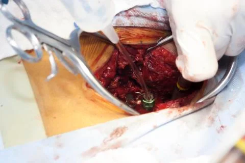 Surgical procedure Foto stock