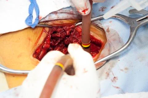 Surgical procedure Foto stock