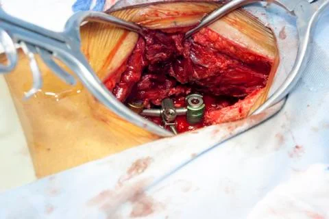 Surgical procedure Stock Photos