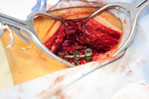 Surgical procedure Stock Photos