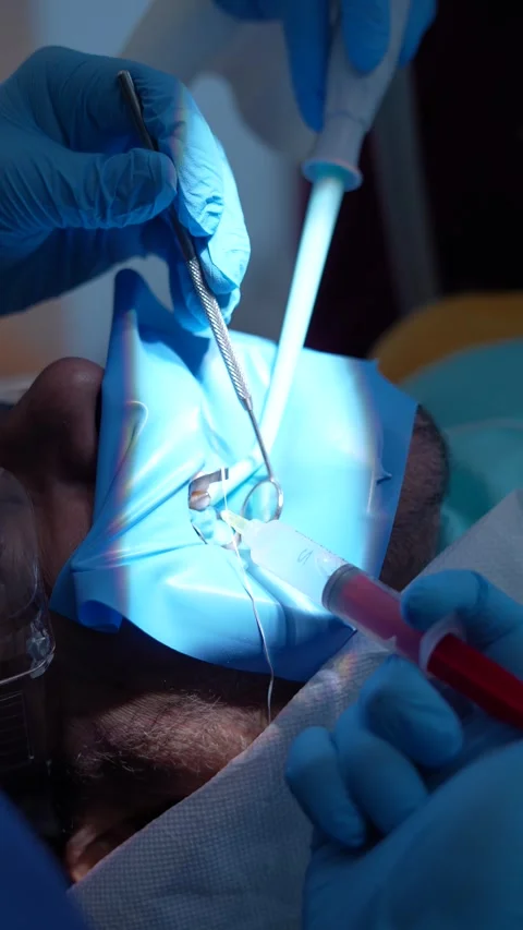 Surgical Procedure in Progress Stock Footage 316916447