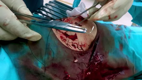 Surgical procedure showing the detailed process of medical knee surgery with Stock Footage 313656229