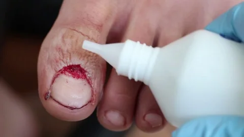 Surgical procedures for nail disorders Stock Footage 84317299
