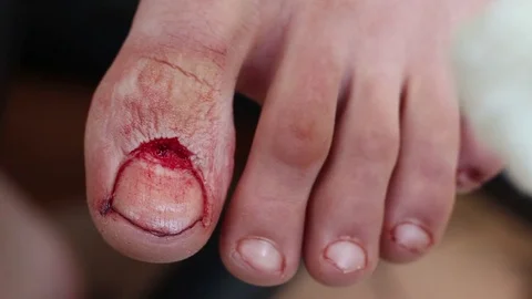 Surgical procedures for nail disorders Stock Footage 84317453