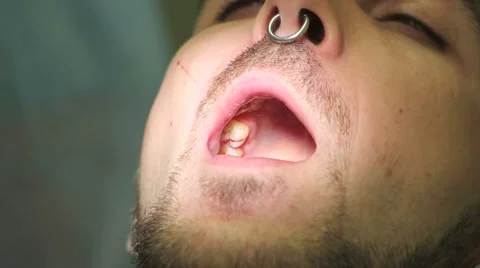 Surgical protocol of dental implants Stock Footage 44906419