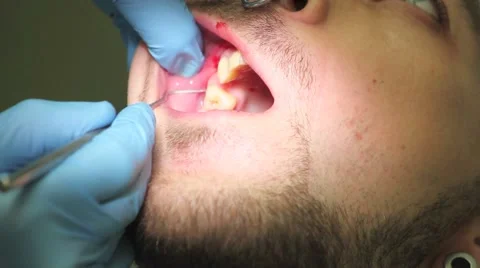 Surgical protocol of dental implants Stock Footage 44906632