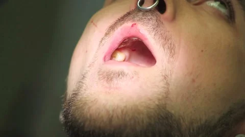 Surgical protocol of dental implants Stock Footage 44906647