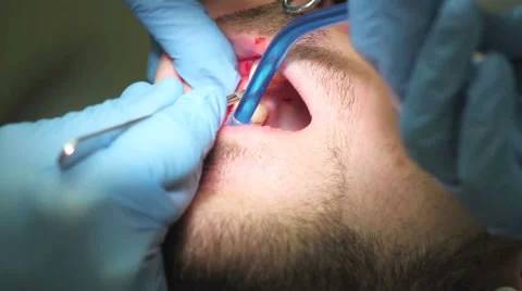 Surgical protocol of dental implants Stock Footage 44906703