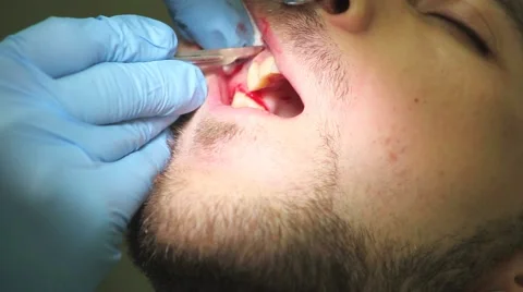 Surgical protocol of dental implants Stock Footage 44906721