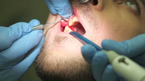 Surgical protocol of dental implants Stock Footage 44906753