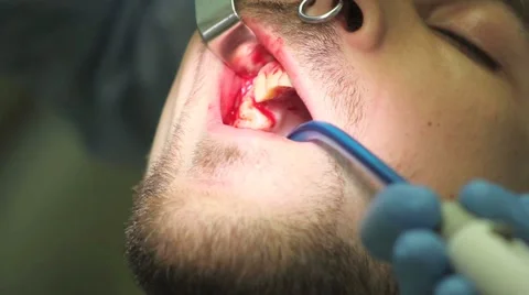 Surgical protocol of dental implants Stock Footage 44906789