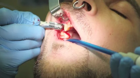 Surgical protocol of dental implants Stock Footage 44906824