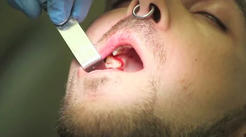 Surgical protocol of dental implants Stock Footage 44906875