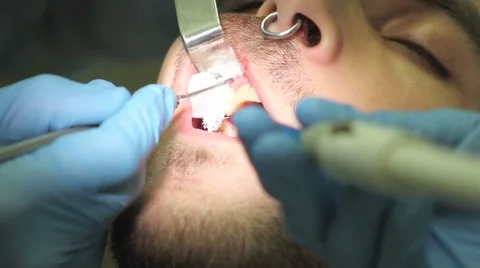 Surgical protocol of dental implants Stock Footage 44907068