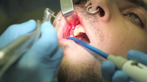 Surgical protocol of dental implants Stock Footage 44907094