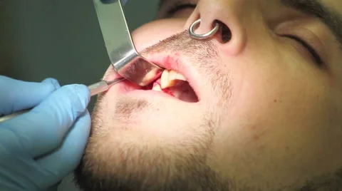 Surgical protocol of dental implants Stock Footage 44907148