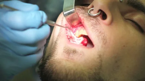 Surgical protocol of dental implants Stock Footage 44907347