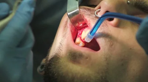 Surgical protocol of dental implants Stock Footage 44907382