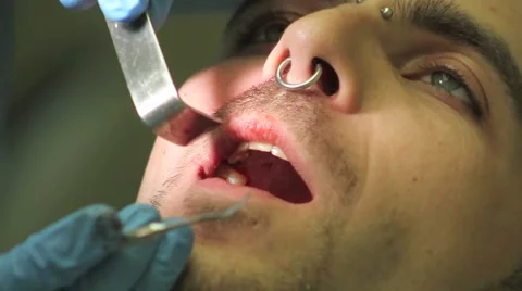 Surgical protocol of dental implants Stock Footage 44907396