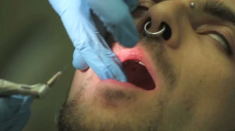 Surgical protocol of dental implants Stock Footage 44907421